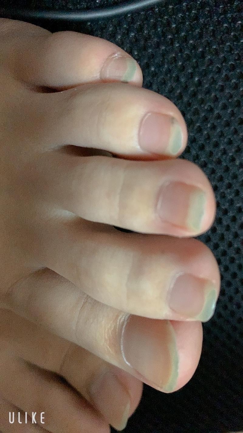足の爪と硬くなった皮と靴下のセット